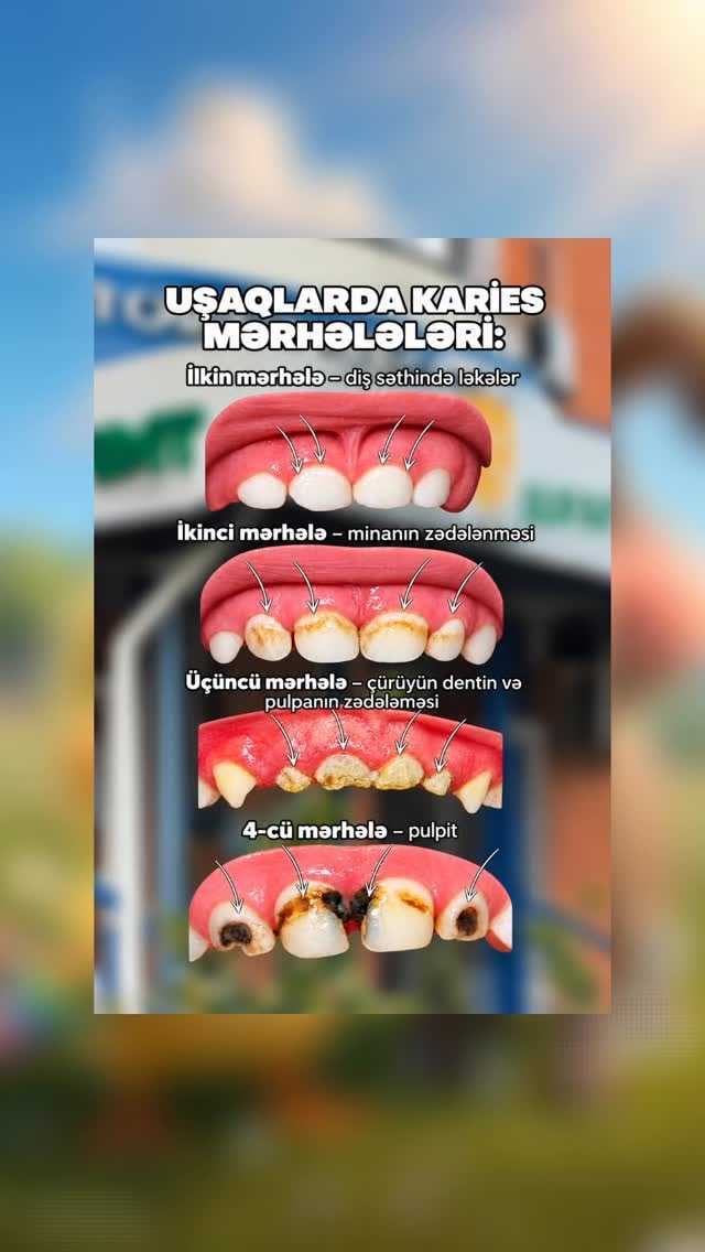 "Kariyes nə qədər sürətlə inkişaf edir?" paylaşımının örtük şəkli